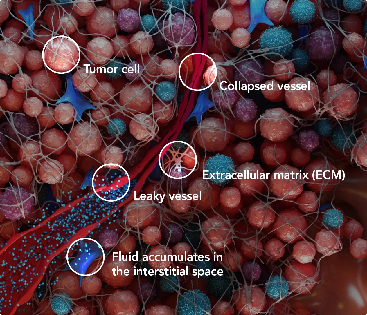 Image that shows what intratumoral pressure looks like 