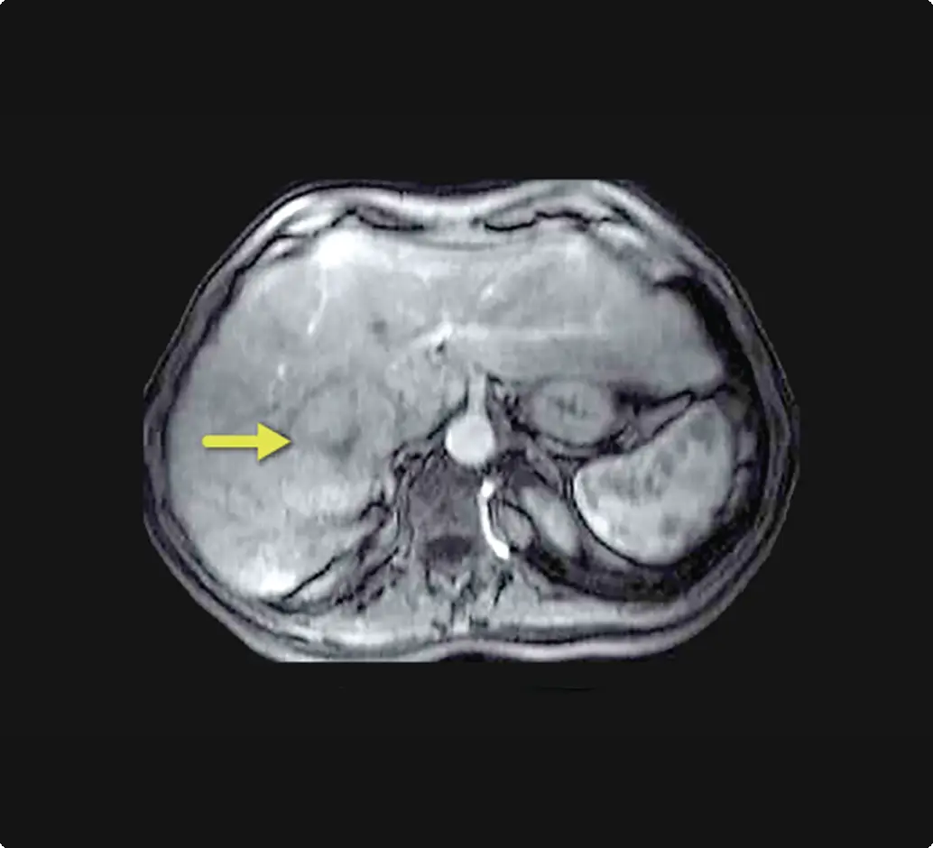 Scan showing borderline liver function