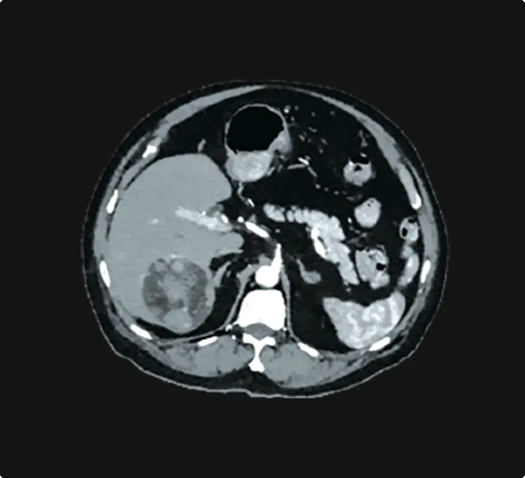 Scan showing a large liver tumor