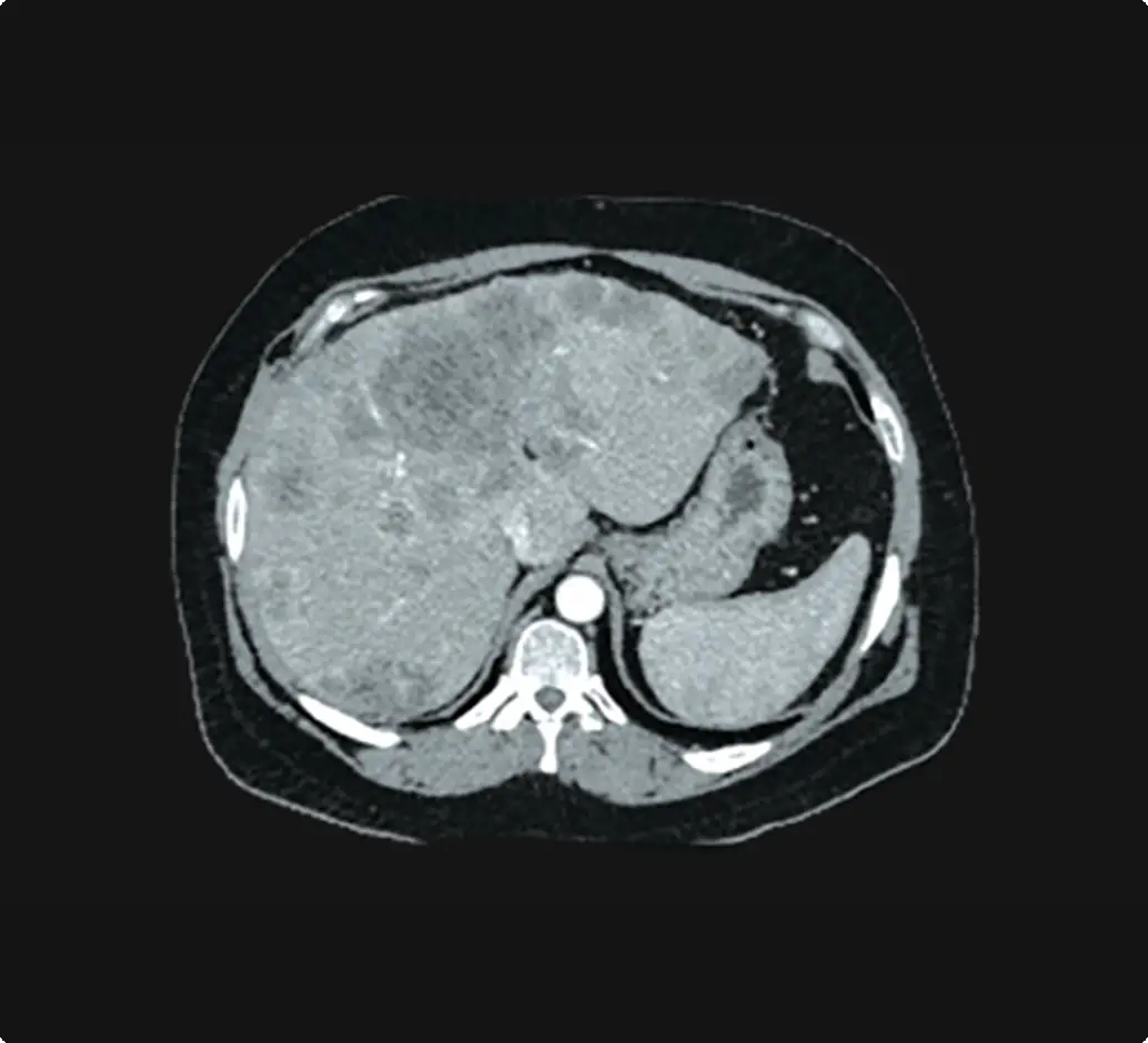 Scan showing multi focal disease
