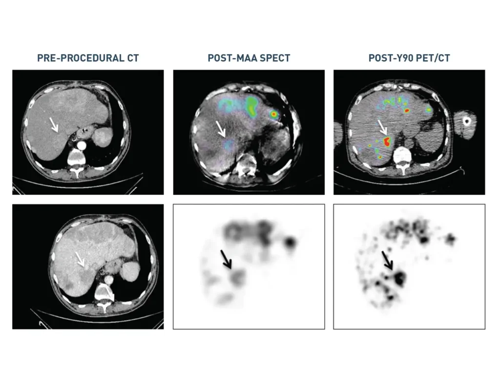 Image comparing therapy delivered by traditional microcatheter