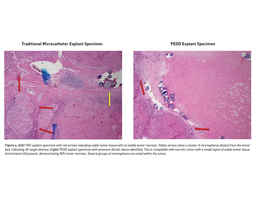 Image that showcases improved clinical outcomes with TriNav Infusion Systems