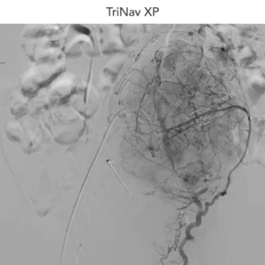 Fluoroscopic angiography image labeled “TriNav XP,” showing contrast-filled blood vessels in the abdomen and liver region with multiple catheter wires visible during an interventional vascular procedure.