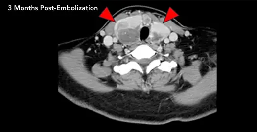 Axial CT scan of the neck labeled 3 Months Post-Embolization, showing a mass surrounding the airway; red arrowheads indicate the treated mass.
