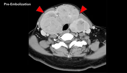 Axial CT scan of the neck labeled Pre-Embolization, showing a large mass surrounding and displacing the airway; red arrowheads indicate the mass.