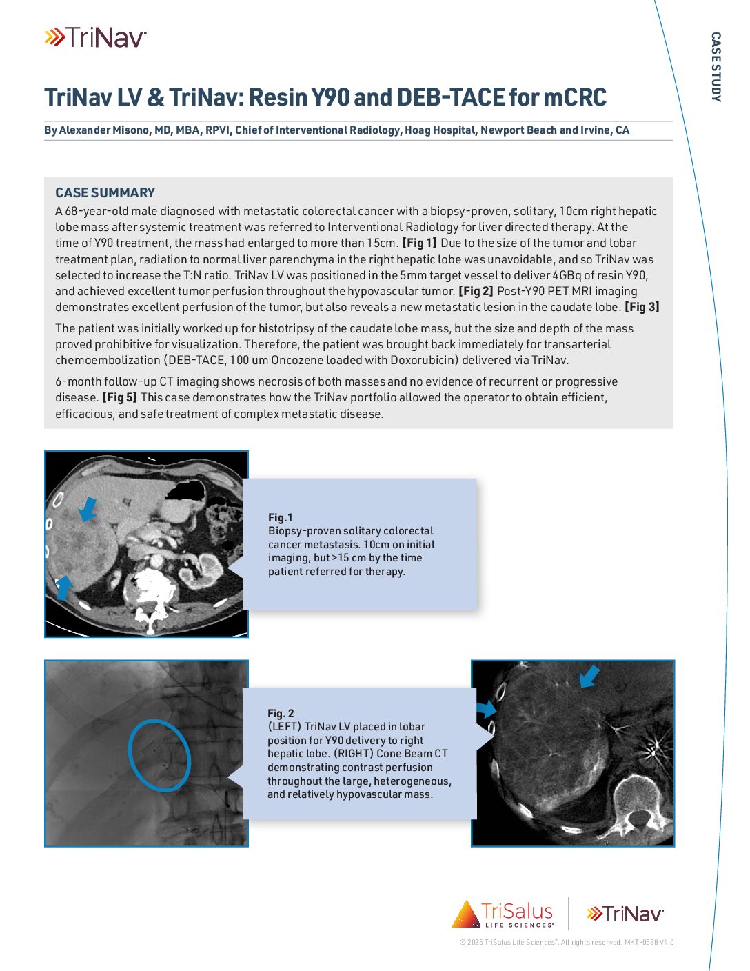 Case Study - Resin Y90 with DEB-TACE for mCRC