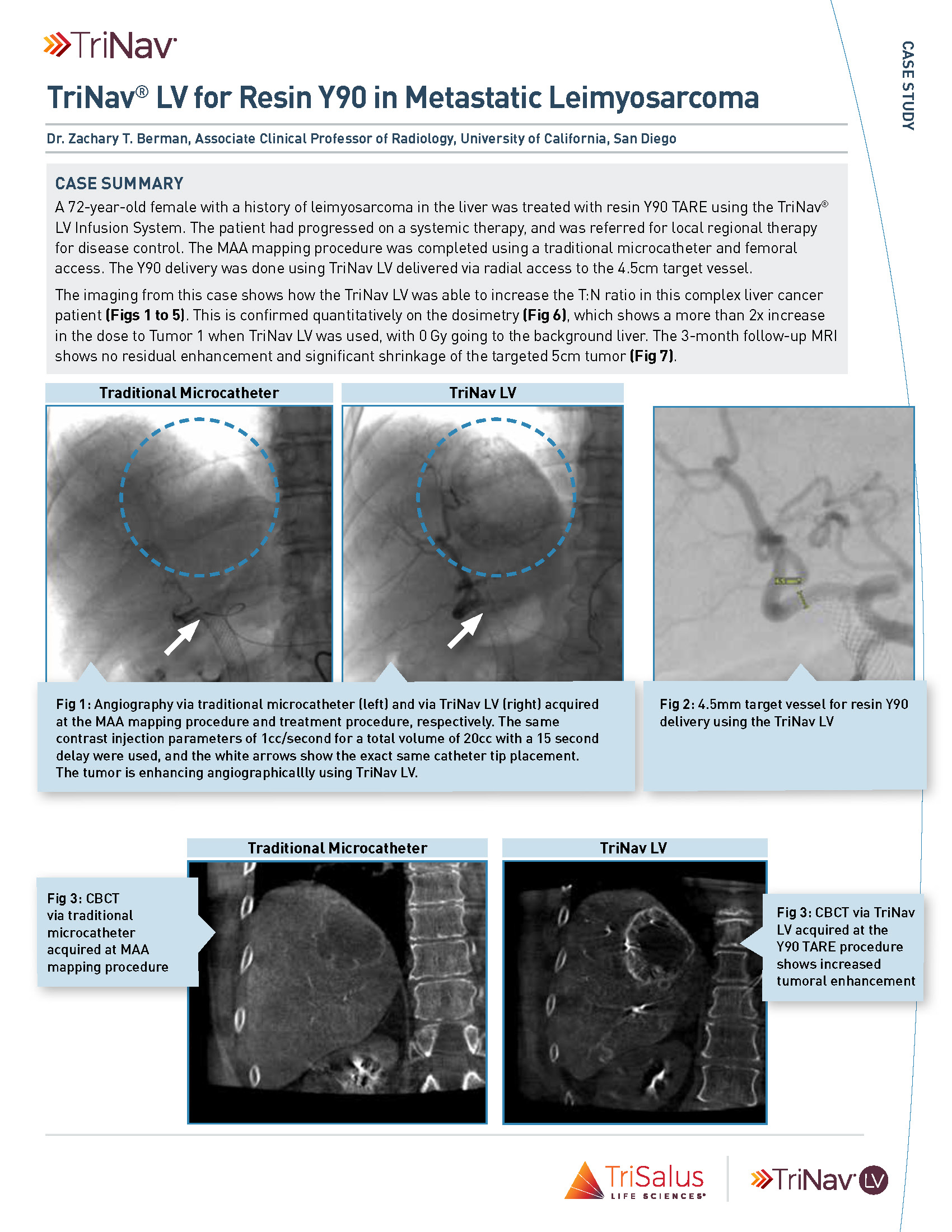 Resin Y90 for Metastatic Leimyosarcoma