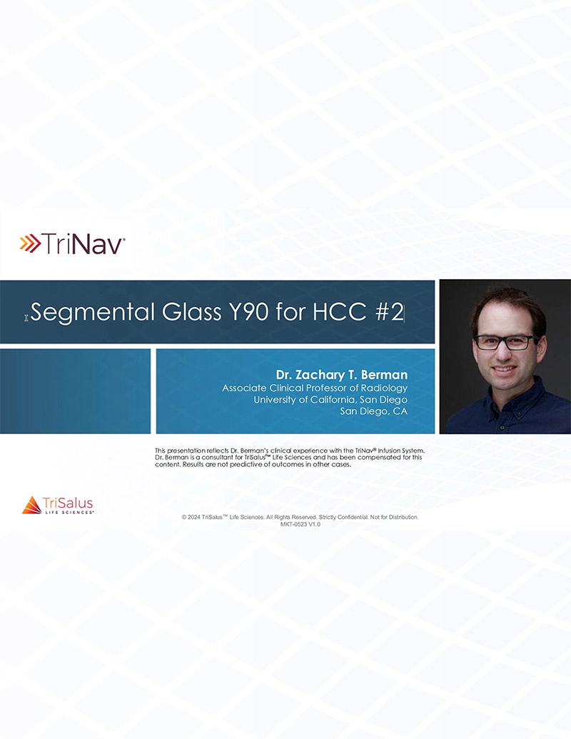 Segmental Glass Y90 for HCC #2