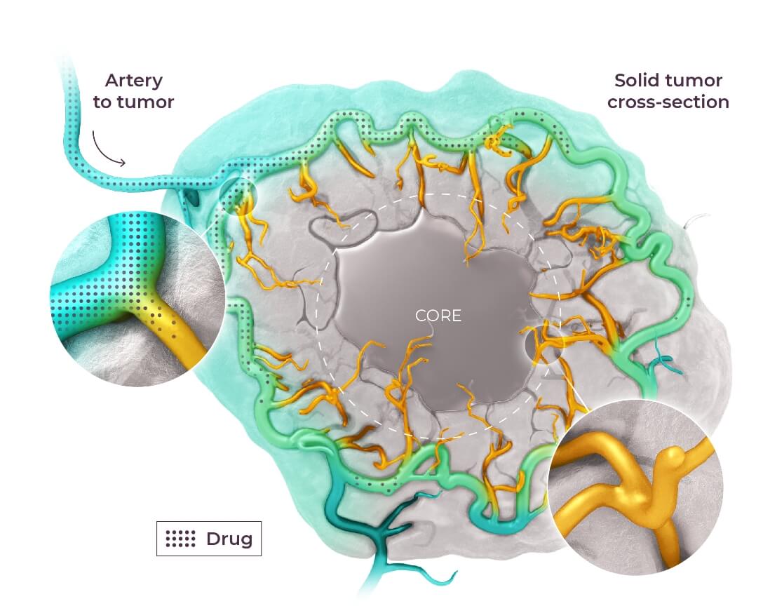 The Role of Ultrasound in Modulating Interstitial Fluid Pressure in Solid  Tumors for Improved Drug Delivery